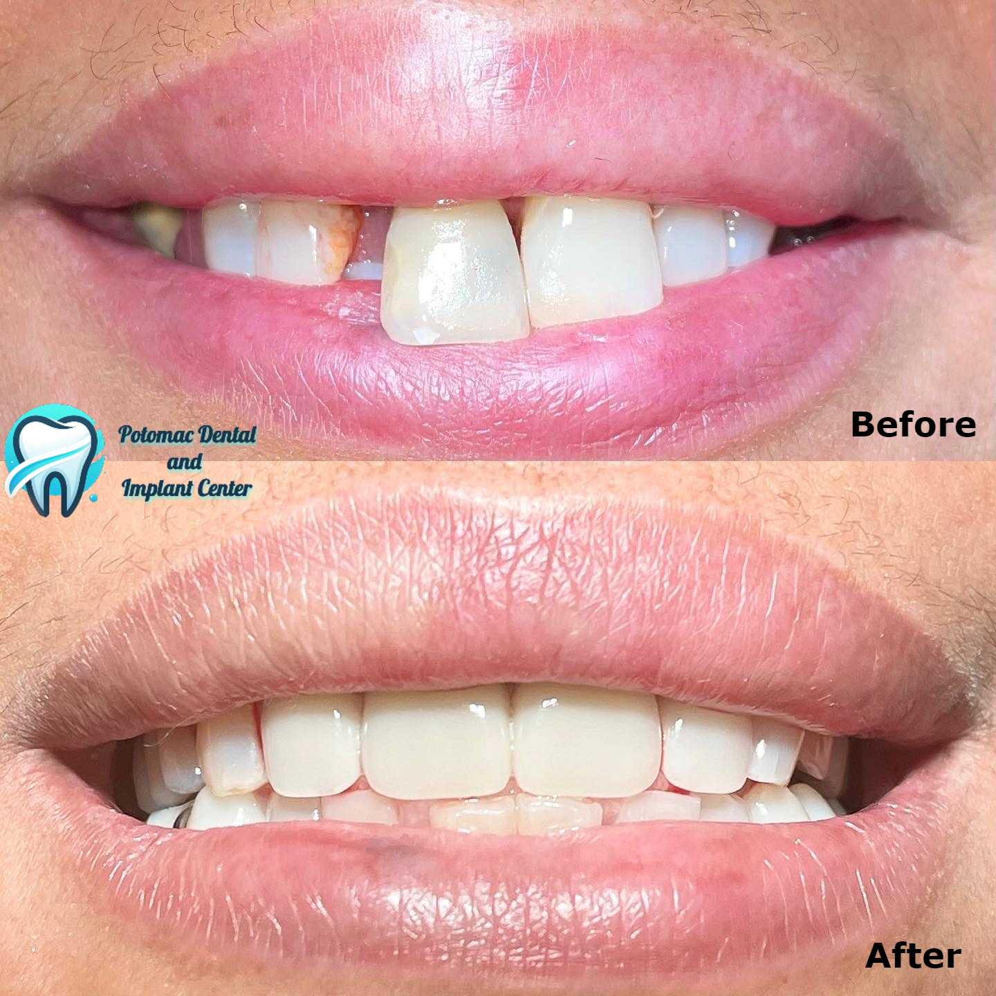 Dental veneers
