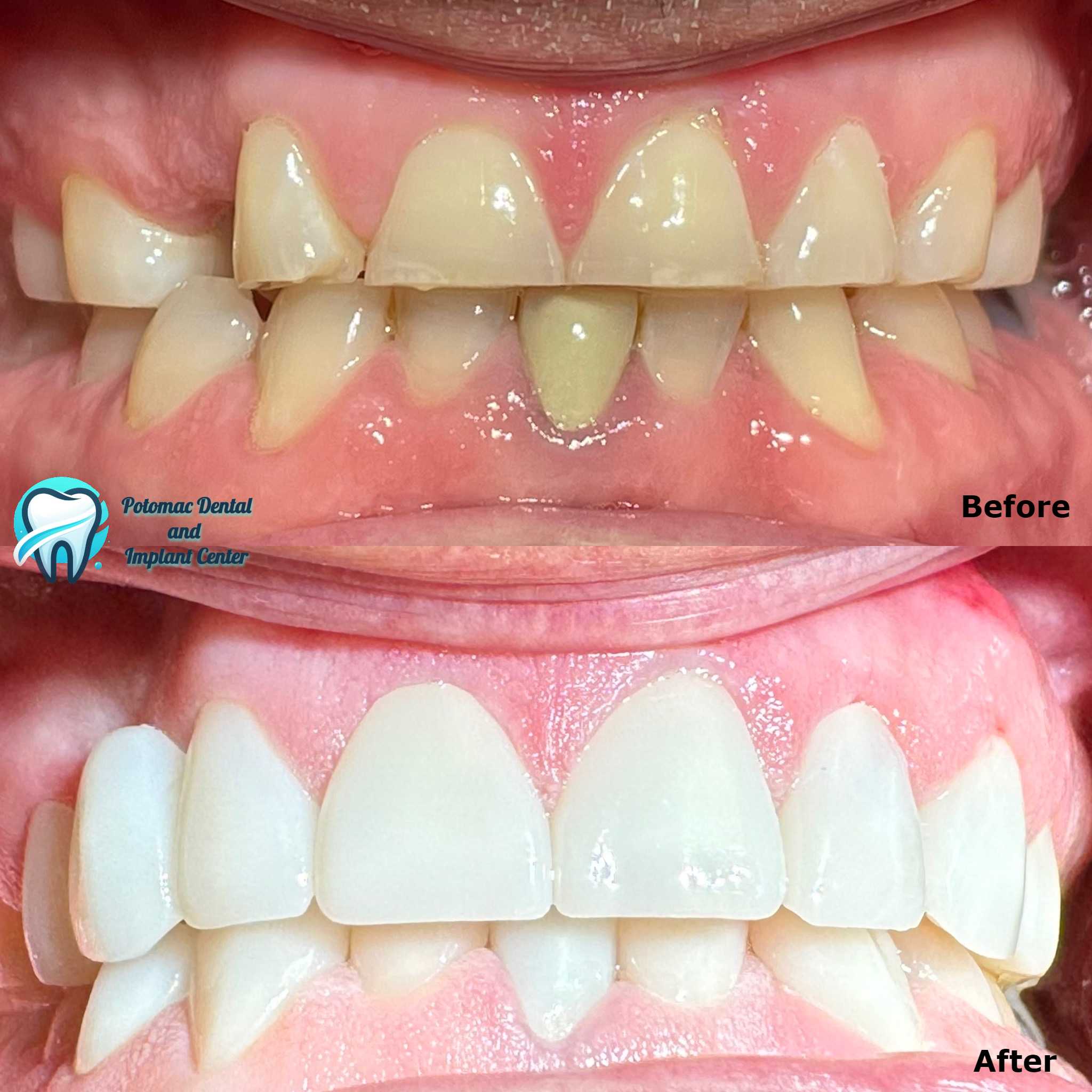 Dental dentures