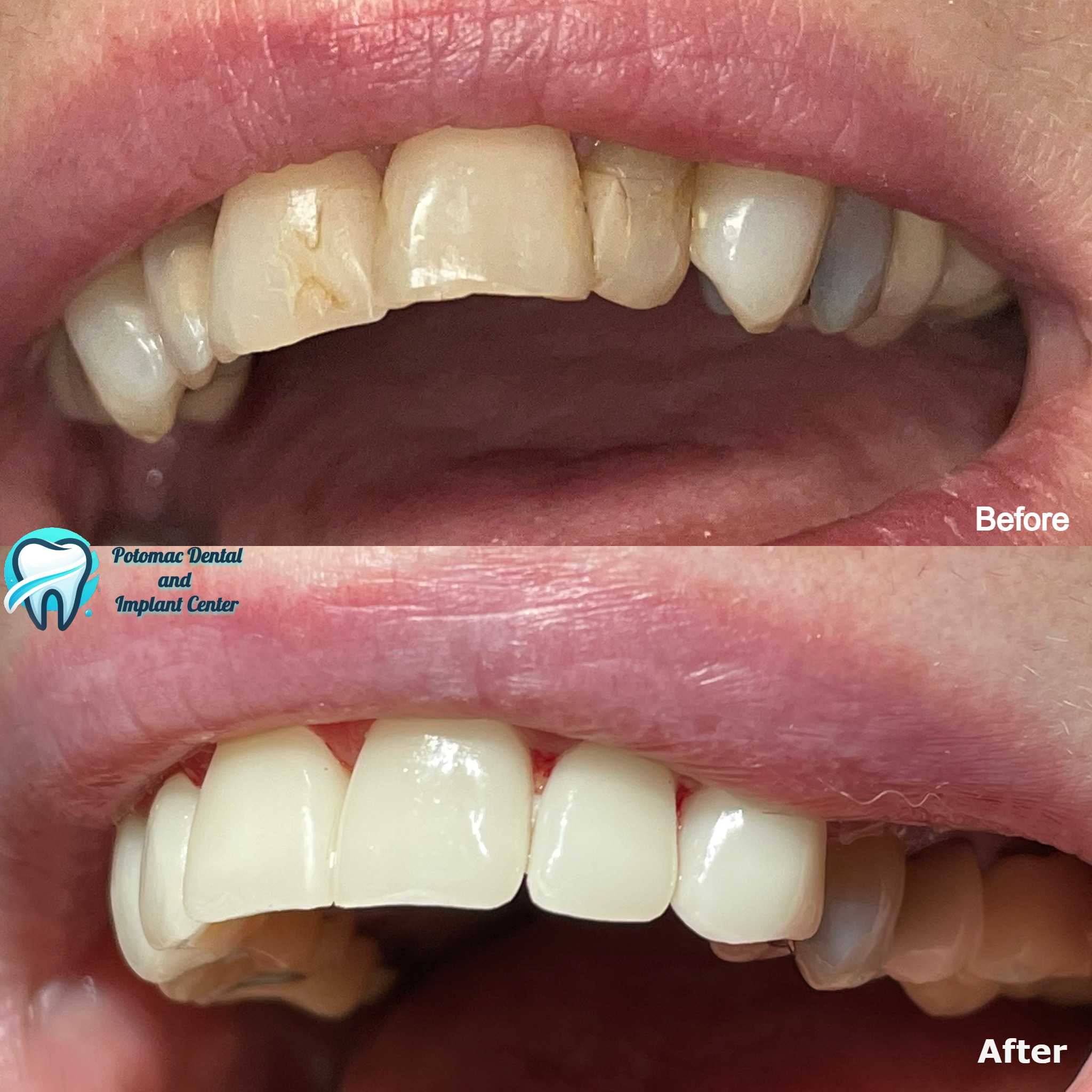 Dental implants