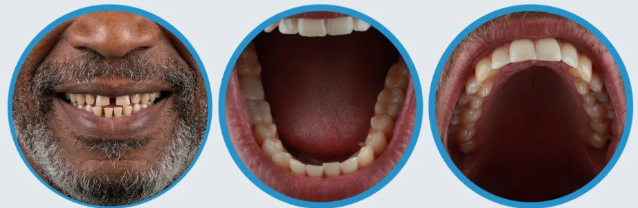 3 sample smile photos needed for virtual consultation: Center, Right side, Left side